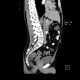 Rudimentary uterus: CT - Computed tomography